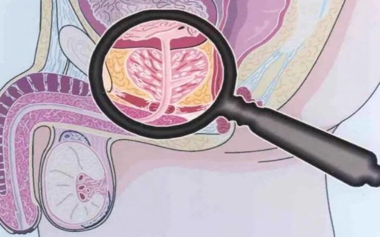 Prostatite crônica